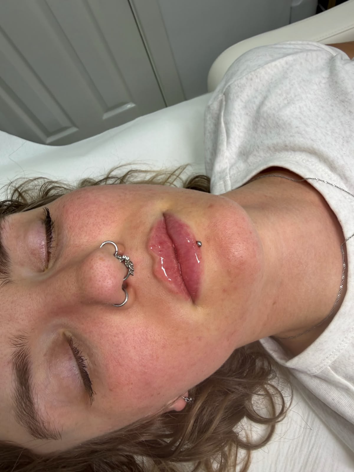 Lip filler treatment finished at Dolly Rocks Aesthetics
